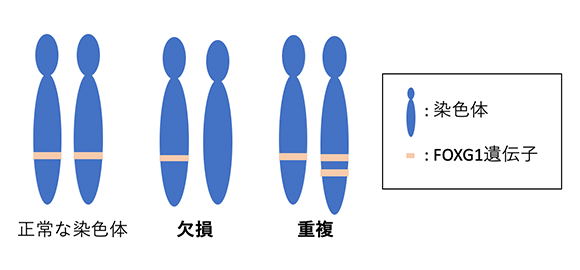 FOXG1遺伝子の設計図であるDNAの変異